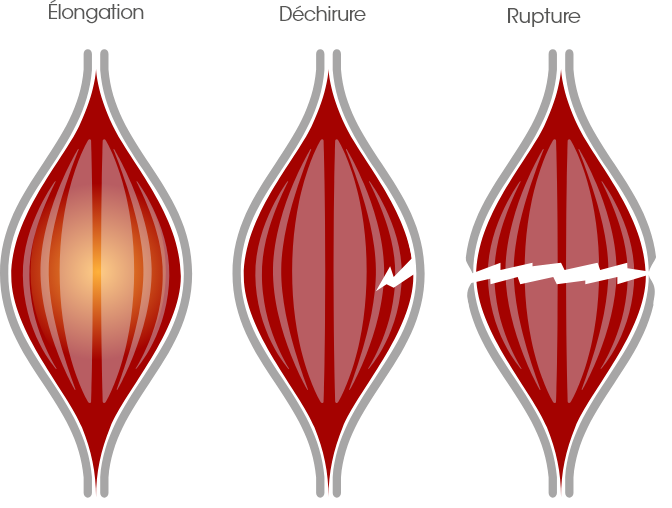 Image Claquages, déchirures musculaires,  tendinites et courbatures